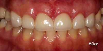 after dental improvements