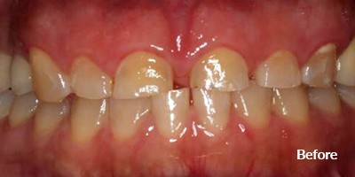 before treatment