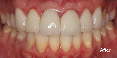 after procedure