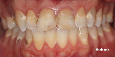 before dental procedure