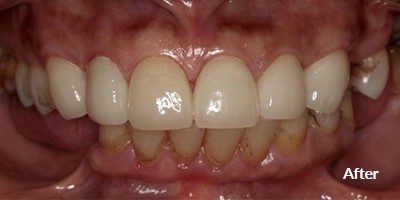after teeth 2