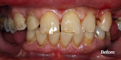 before dentist