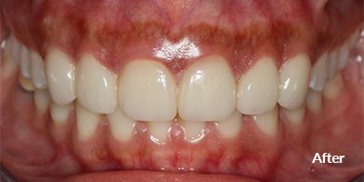 after procedure