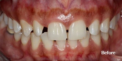 before gum treatment