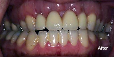 after treatment