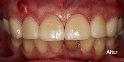 after teeth