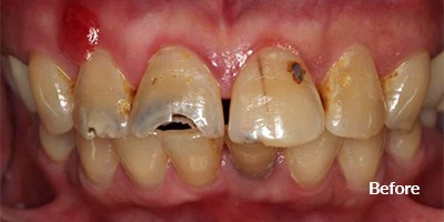 before teeth
