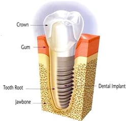 dental implant