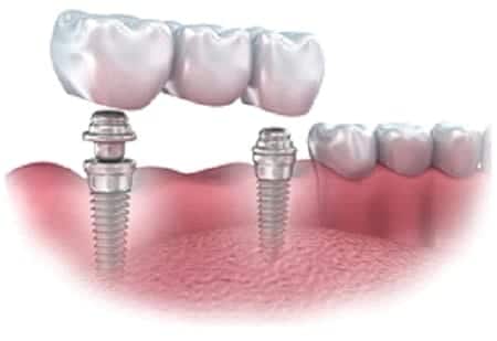 oral bridge implants for missing teeth in orland park and chicago