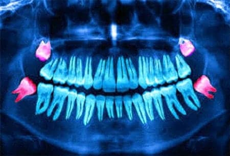emergency dental implants